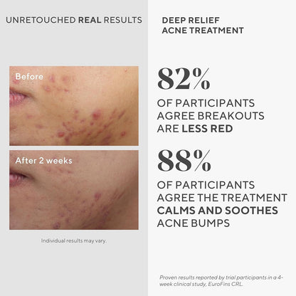 Murad Deep Relief Acne Spot Treatment
